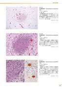 p171_肉芽腫性脳炎.jpg